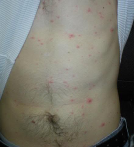 chickenpox stages. chickenpox