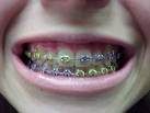 braces Pictures, Images and Photos