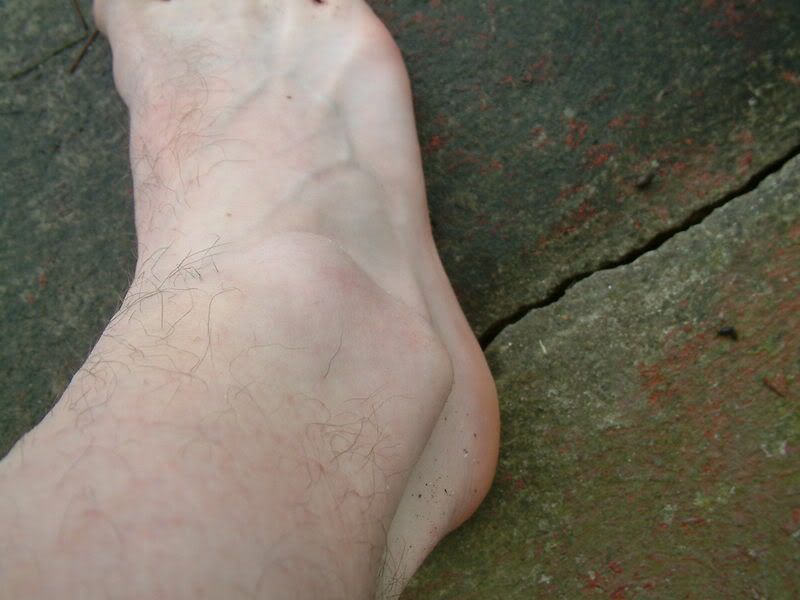 Bumps On Ankles
