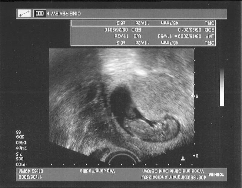 If baby is upside down Update on first post in Ultrasound Gender