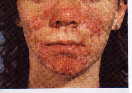 Acne Wiki