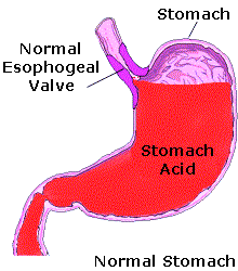cartoon stomach ulcer