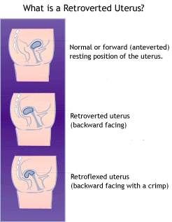 Retroverted Uterus