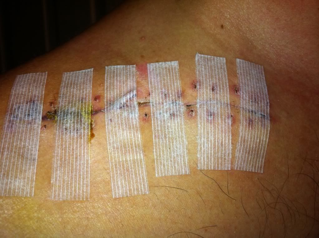 leaking incision 2 weeks post clavicle op Health & Fitness ThumperTalk