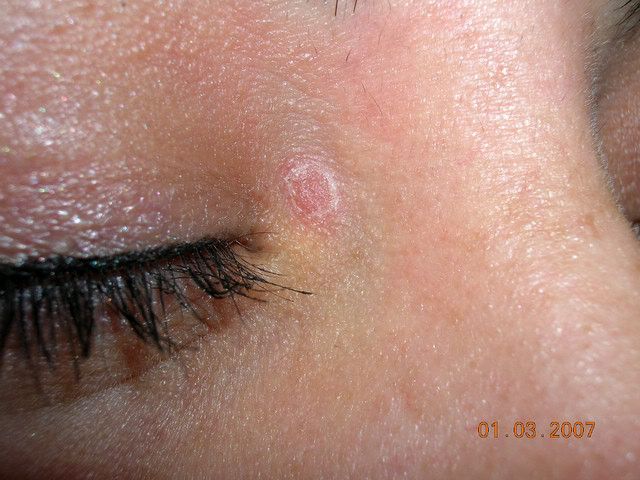 psoriasis on eyelid
